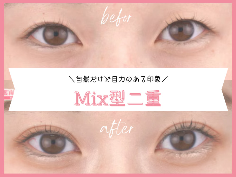 池袋　二重デザイン　Mix型二重